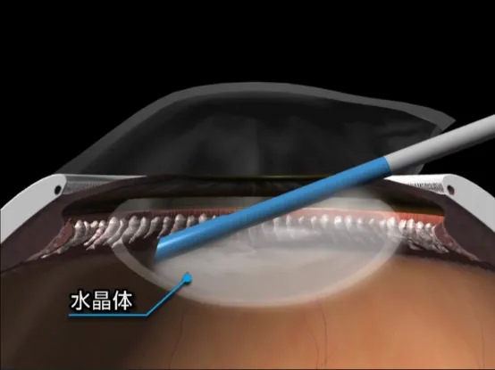濁った水晶体を吸引します