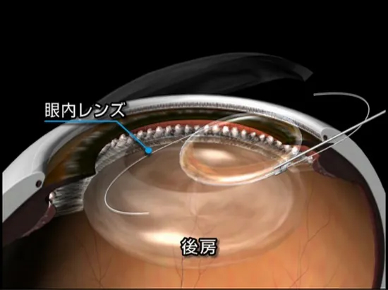 眼内レンズを挿入します