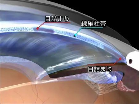 （1）開放隅角(かいほうぐうかく)緑内障