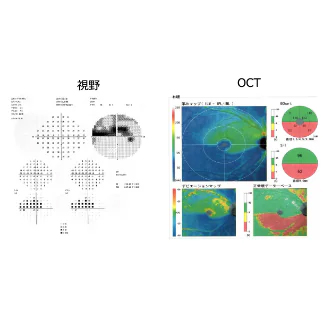 OCTと視野検査