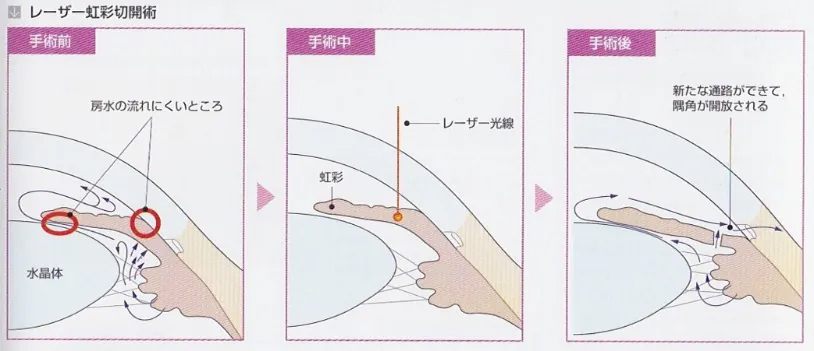 レーザー虹彩切開術