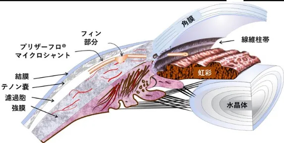 プリザーフロ断面図