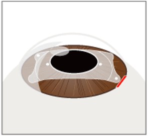 STEP3 レンズを虹彩と水晶体の間に固定します。同行を縮小させ終了です。
