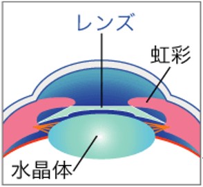 STEP3 レンズを虹彩と水晶体の間に固定します。同行を縮小させ終了です。