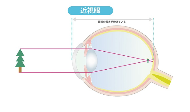 近視眼