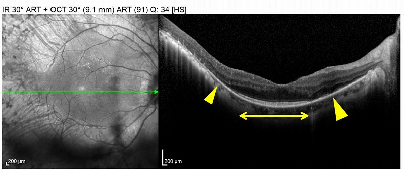 網膜色素変性症の光干渉断層計