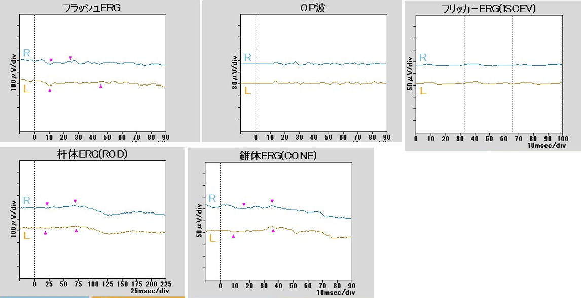 網膜色素変性の網膜電図