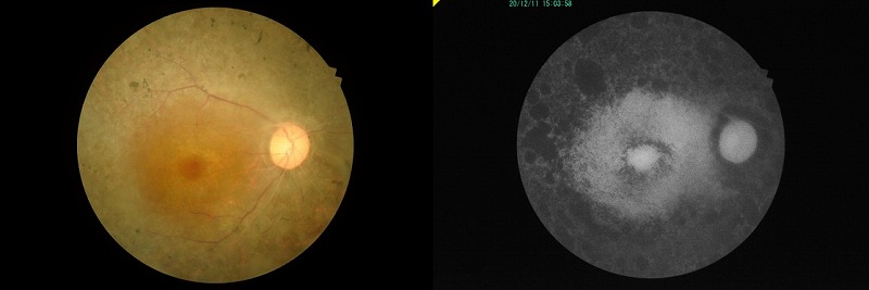 網膜色素変性の眼底写真と同じ眼の眼底自発蛍光