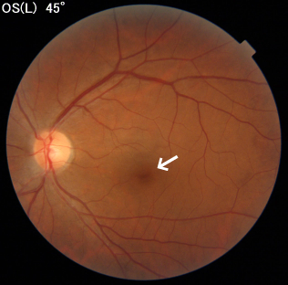 図1 左眼の眼底写真。矢印の部分が黄斑