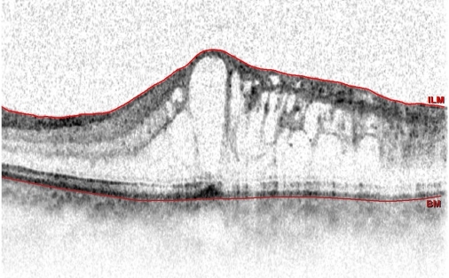 図4-b 網膜静脈分枝閉塞症による黄斑部浮腫のOCT