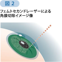 図2 フェムトセカンドレーザーによる角膜切除イメージ像