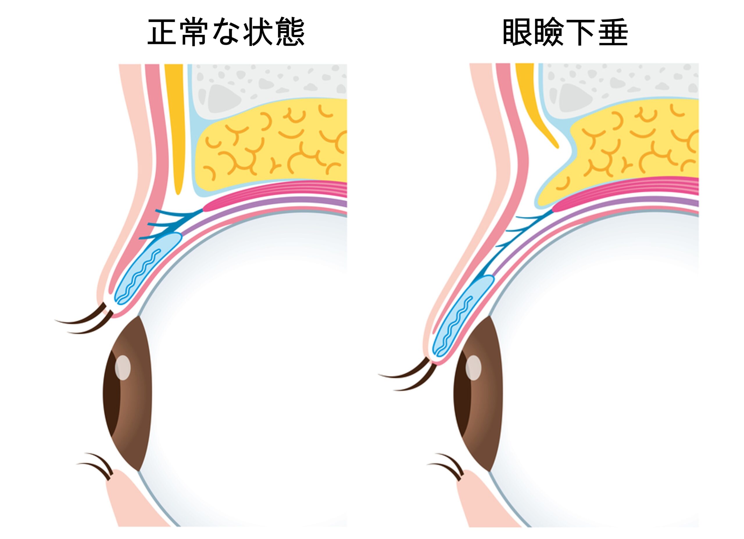 眼瞼下垂